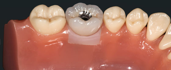 kaufen Hochesthetische Edelmetallkronenimplantate Kronenbrücke Metalllegierungen online manufacture