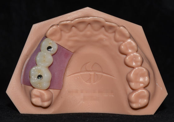 kaufen Implantat Porzellan mit Zirkonie verschmolzen Implantat Kronenbrücke sehr ästhetisch online manufacture