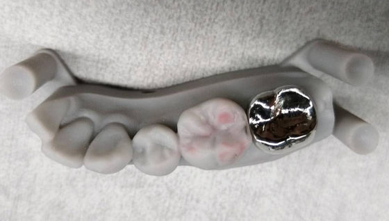 kaufen Vollmetallische nicht edelwertige Kronenimplantate PFM Krone und Brückenprofi online manufacture