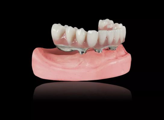 kaufen Implantat Titanstahl Abnehmbare Zahnprothesen Titanstahl Implantatstahl Überpräparate online manufacture