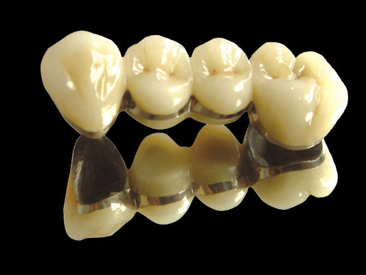 kaufen Edelmetallbrücke Implantat Kronenbrücke Verschleißbeständig angepasst online manufacture
