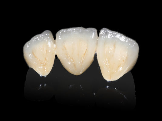 kaufen Implantate Zahnpflege PFM Brücke Nicht wertvoll CAD CAM PFM Krone online manufacture