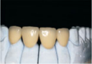 kaufen Weiße Hochedle Edelmetallkrone und Brücke Genau und benutzerdefiniert online manufacture