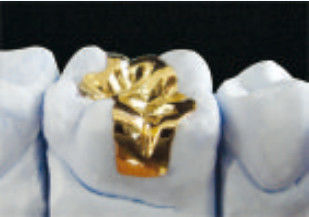 Ausgezeichnete Zahn Gold Onlay CE und FDA Gold Inlays und Onlays