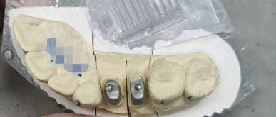 Metallische / natürliche Ti-Basis-Kronen Post-Kern-Titan-Kronen für Zähne