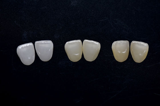 Hochesthetische Zirkonia Veneer Langlebige Zirkonia Emax Veneer