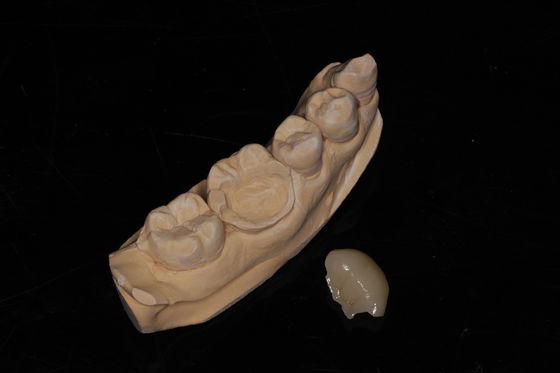 Dental Composite Onlay Veneer Hohe Ästhetik Komposit Veneer