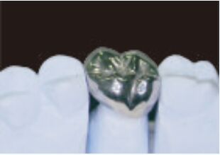 Vollmetallkrone und Brücke Hochgenauigkeit Silber temporäre Krone